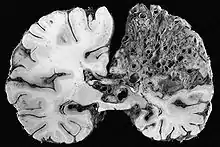 Importante malformation artério-veineuse dans la région du cerveau, le tissu a été majoritairement remplacé par le conglomérat vasculaire pathologique.