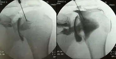 Arthrographie d'une épaule gauche