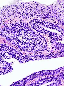 Papillome urothélial inversé de la vessie. HE, x400.