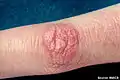papules de Gottron (dermatomyosite juvénile)