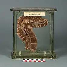 Portion de colonne vertébrale atteinte du mal de Pott.