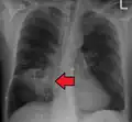 Abcès pulmonaire sur CXR