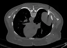 Coupe tomodensitométrique montrant une tumeur intrathoracique où est plantée une aiguille à biopsie.