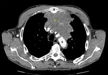 Coupe tomodensitométrique injectée montrant une volumineuse tumeur du médiastin antérieur.