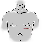 Thoracotomie antérieure gauche.