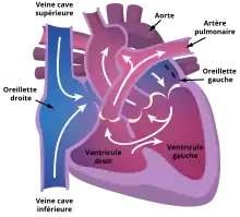Schéma d’un cœur présentant une atrésie tricuspide.