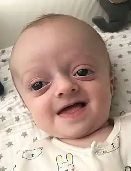 Description de l'image Baby with Crouzon Syndrome.jpg.