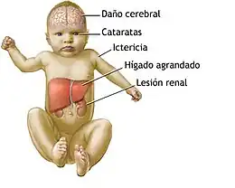 Description de l'image Bebe Galactosemia.jpg.