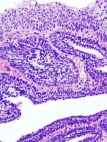 Papillome urothélial inversé de la vessie. HE, x400.