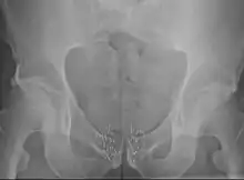 Grains de curiethérapie utilisés pour traiter le cancer de la prostate.