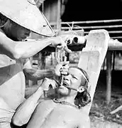 Extraction des dents par fracture