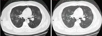 Stade 2 (progressif)