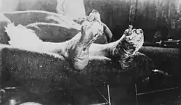 Pied de tranchée (infection ulcérative qui touchait les soldats de la Première Guerre mondiale).