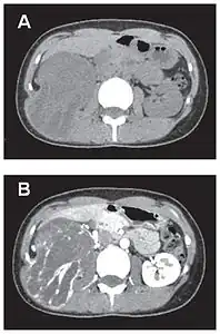 Comparaison côte à côte de deux coupes scanner.