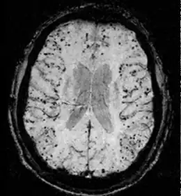 Description de l'image Cerebral amyloid angiopathy (CAA)-MRI.png.