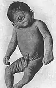 Enfant atteint de cyclopie, 1926.