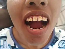 Description de l'image Dental Flurosis (teeth with brown stains).jpg.