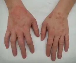 Description de l'image Dermatitis2015.jpg.