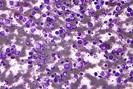 Description de l'image Diffuse large B cell lymphoma - cytology low mag.jpg.