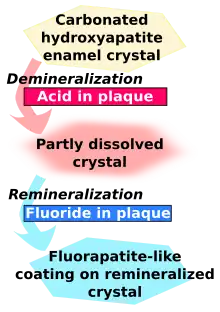 Carbonated hydroxyapatite enamel crystal is demineralized by acid in plaque and becomes partly dissolved crystal. This in turn is remineralized by fluoride in plaque to become fluorapatite-like coating on remineralized crystal