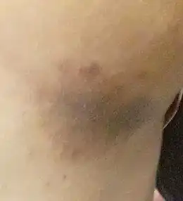 Description de l'image Erythrasma.jpg.