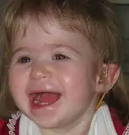 Description de l'image Facial Features of a Child with 1p36 Deletion Syndromel.png.