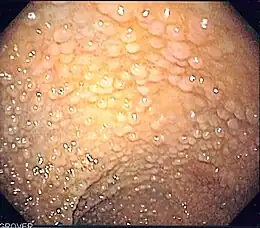 Description de l'image Familial adenomatous polyposis as seen on sigmoidoscopy.jpg.