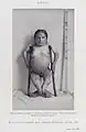 Femme souffrant de nanisme et de rachitisme, vers 1912.