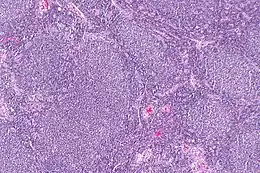 Description de l'image Follicular lymphoma -- low mag.jpg.