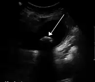 Image illustrative de l’article Colique hépatique