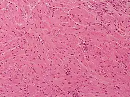 Description de l'image Granular cell tumor Case 174 (5600864519).jpg.