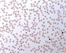 Description de l'image Haemolytic Anaemia.jpg.