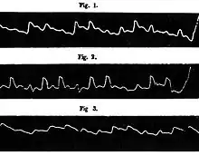Pouls paradoxal de Kussmaul
