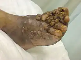 Description de l'image Madura foot.jpg.