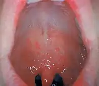 Image illustrative de l’article Énanthème