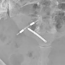 Dispositif médical en forme de T, plus blanc que les autres structures