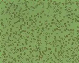 Description de l'image Microcytosis.jpg.