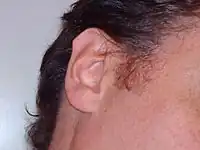 Tubercule auriculaire postérieur et pointu.