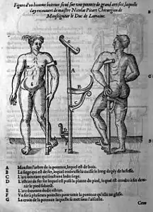Ambroise Paré, Figure d'un homme boiteux situé sur une potence de grand artifice, 1585.