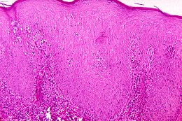 Description de l'image Pinta (disease).jpg.