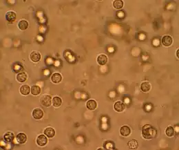 Description de l'image Pyuria.JPG.