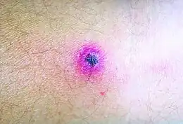 Description de l'image Rickettsialpox lesion.jpg.