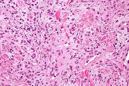 Champ de cellules roses aux noyaux pourpres, séparées de plages de collagène fuchsia.