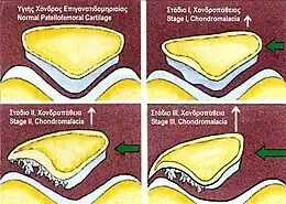 Description de l'image Stages of chindromalacia of patellofemoral joint.jpg.