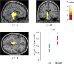 Description de l'image Statistical parametric maps of BPND of 11C-(R)-PK11195 in CFS.ME patients and healthy controls.gif.