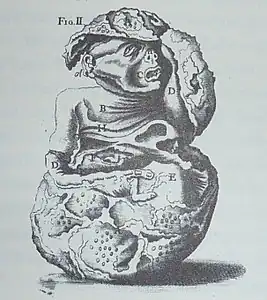 Représentation d'un lithopédion au XVIIIe&nbsp;siècle.