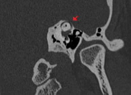 Description de l'image Superior semicircular canal dehiscence syndrome - CT scan.gif.