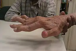 Description de l'image Swan neck deformity in a 65 year old Rheumatoid Arthritis patient- 2014-05-27 01-49.jpg.