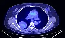 Coupe axiale de TEP thoracique.