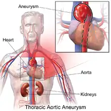 Description de l'image Thoracic Aortic Aneurysm.png.
